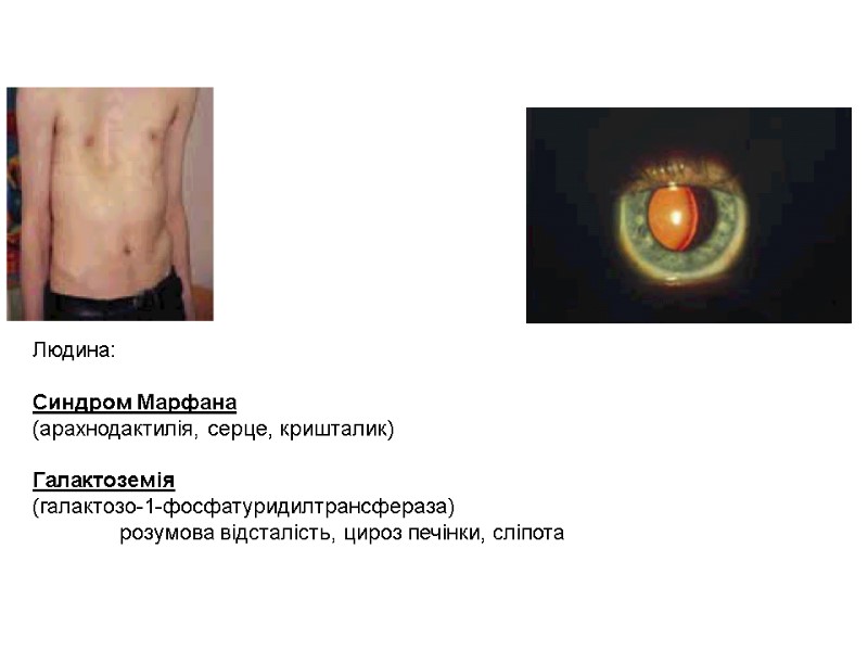 Людина:   Синдром Марфана  (арахнодактилія, серце, кришталик)  Галактоземія  (галактозо-1-фосфатуридилтрансфераза) 